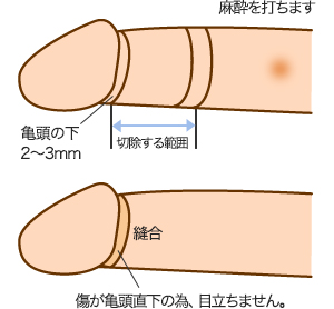 手術 ほう 2 傷口 けい 週間