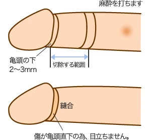 包茎治療