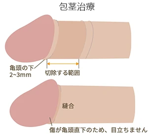 包茎治療