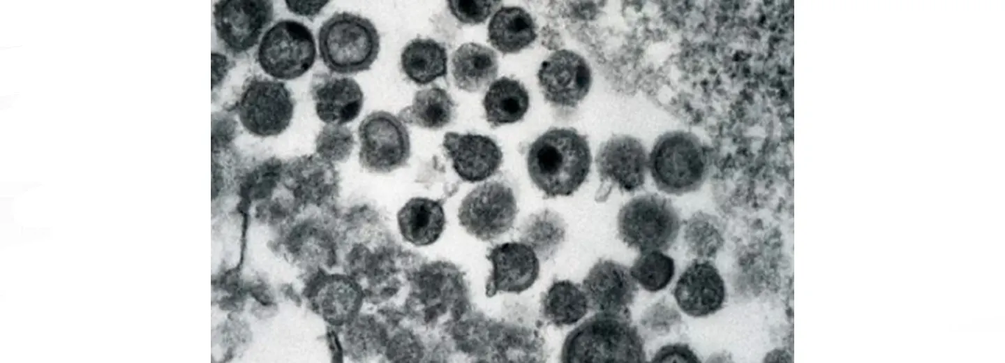 HIV